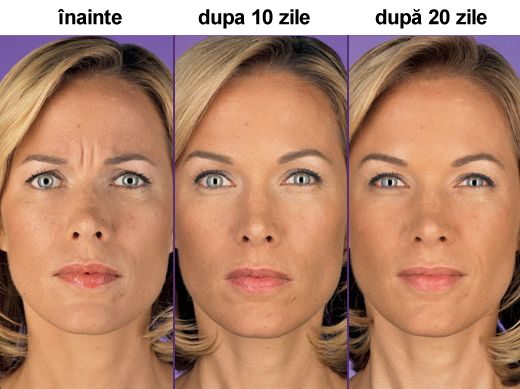 botox-inainte-dupa