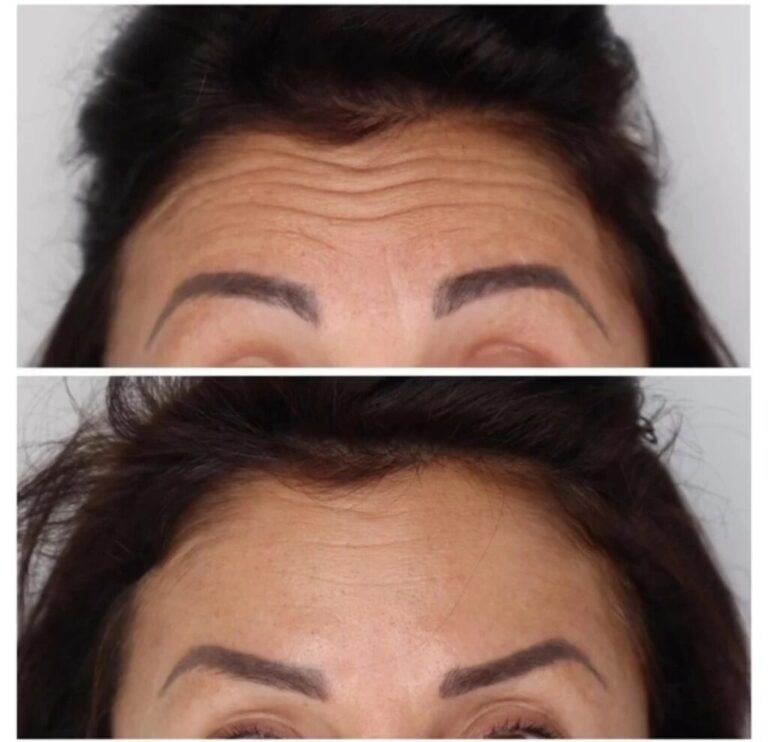 tratament-botox-luxury-aesthetics-14-1024x989